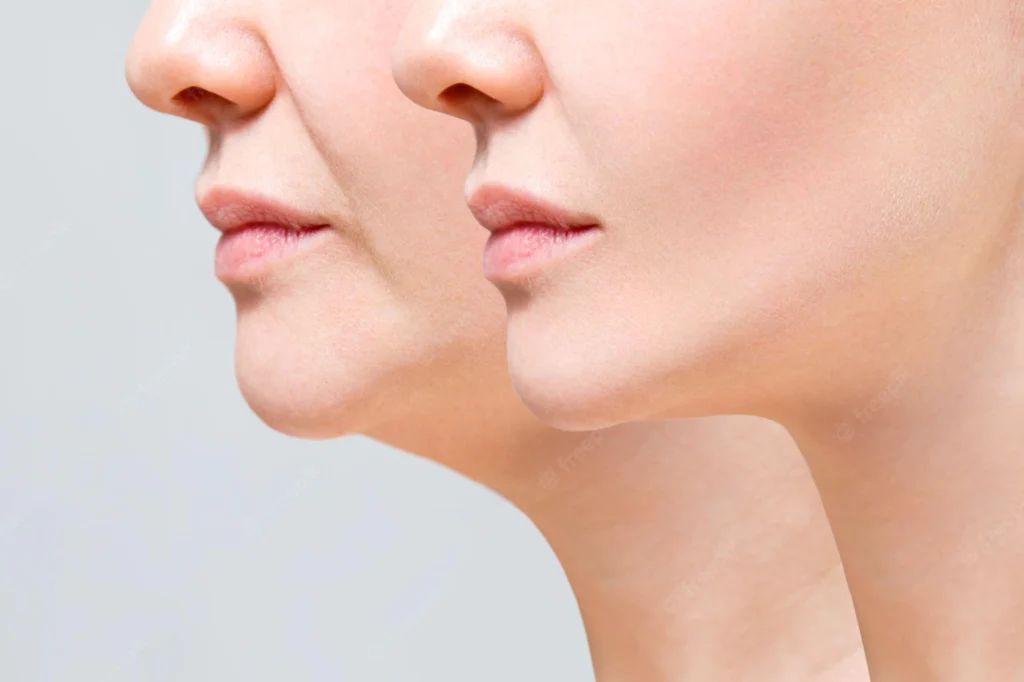 Facial Slimming - How to Get Rid of Facial Fat