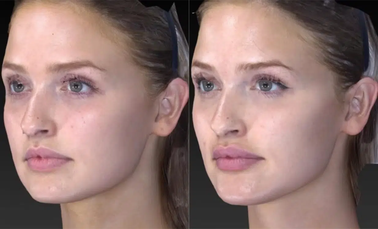 Chin Filler before and after