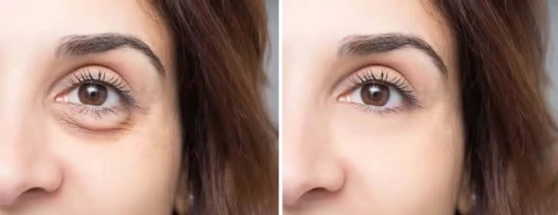 Under Eye Filler before after